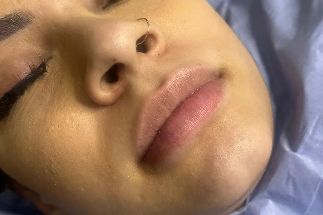 Before-Lip Filler